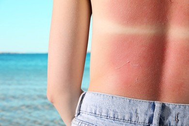 Image of Woman with sunburned skin against sea, back view