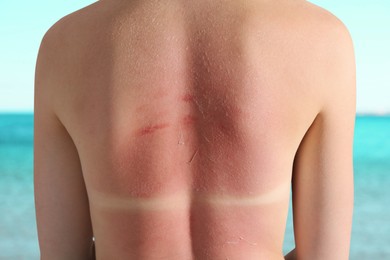 Image of Woman with sunburned skin against sea, back view