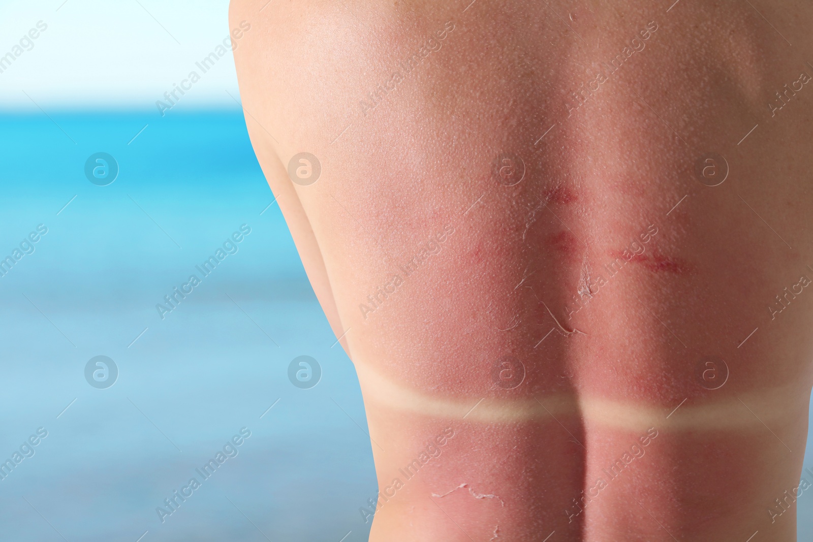 Woman with sunburned skin against sea, back view Image of Woman with sunburned skin against sea, back view