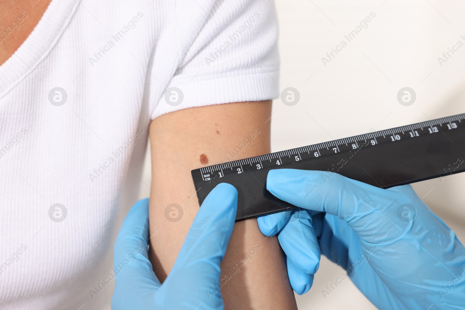 Doctor examining young woman's mole with ruler on white background, closeup Photo of Doctor examining young woman's mole with ruler on white background, closeup