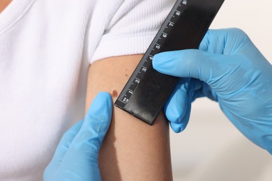 Photo of Doctor examining young woman's mole with ruler on white background, closeup