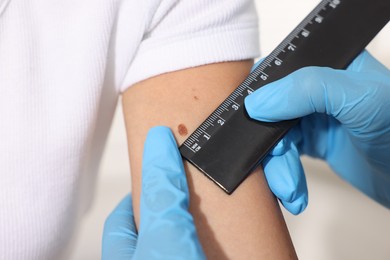 Photo of Doctor examining young woman's mole with ruler on white background, closeup