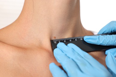 Photo of Doctor examining young woman's mole with ruler on white background, closeup
