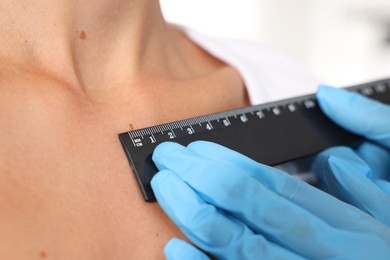 Photo of Doctor examining young woman's mole with ruler on white background, closeup