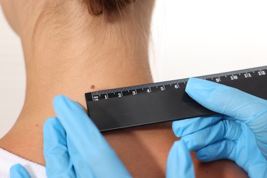 Photo of Doctor examining young woman's mole with ruler on white background, closeup