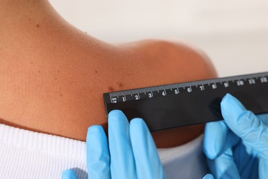 Photo of Doctor examining young woman's mole with ruler on white background, closeup