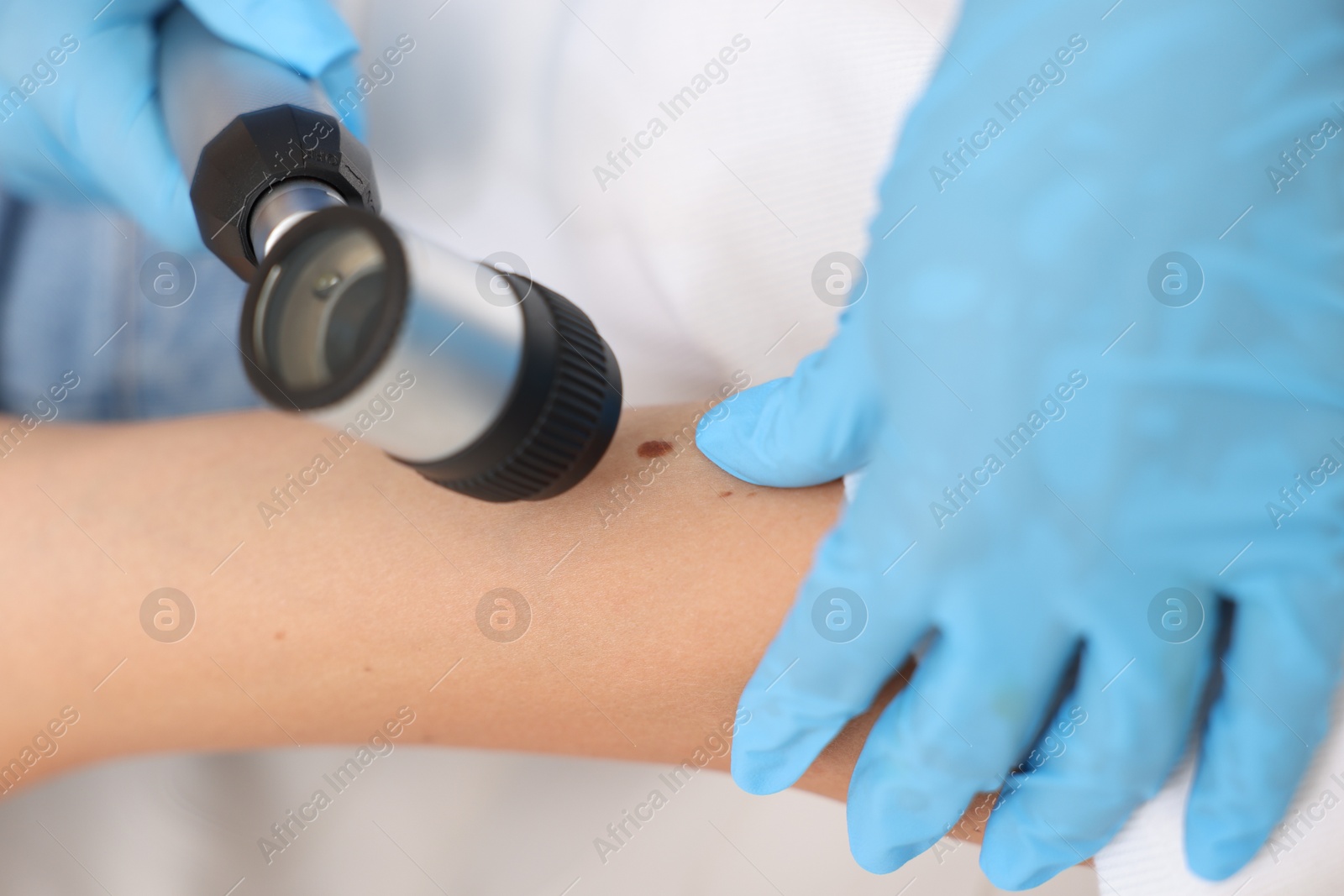 Doctor examining young woman's mole with dermatoscope in hospital, closeup Photo of Doctor examining young woman's mole with dermatoscope in hospital, closeup