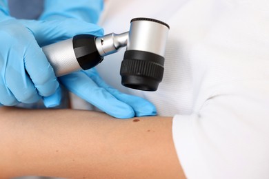 Photo of Doctor examining young woman's mole with dermatoscope in hospital, closeup