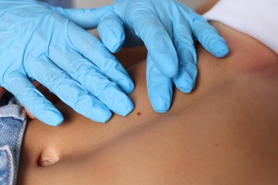 Photo of Doctor examining young woman's mole in hospital, closeup