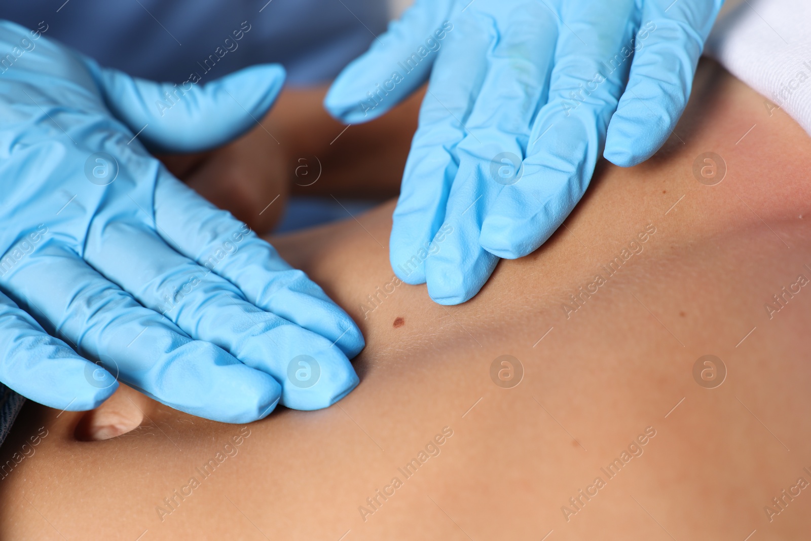 Doctor examining young woman's mole in hospital, closeup Photo of Doctor examining young woman's mole in hospital, closeup
