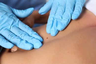 Photo of Doctor examining young woman's mole in hospital, closeup