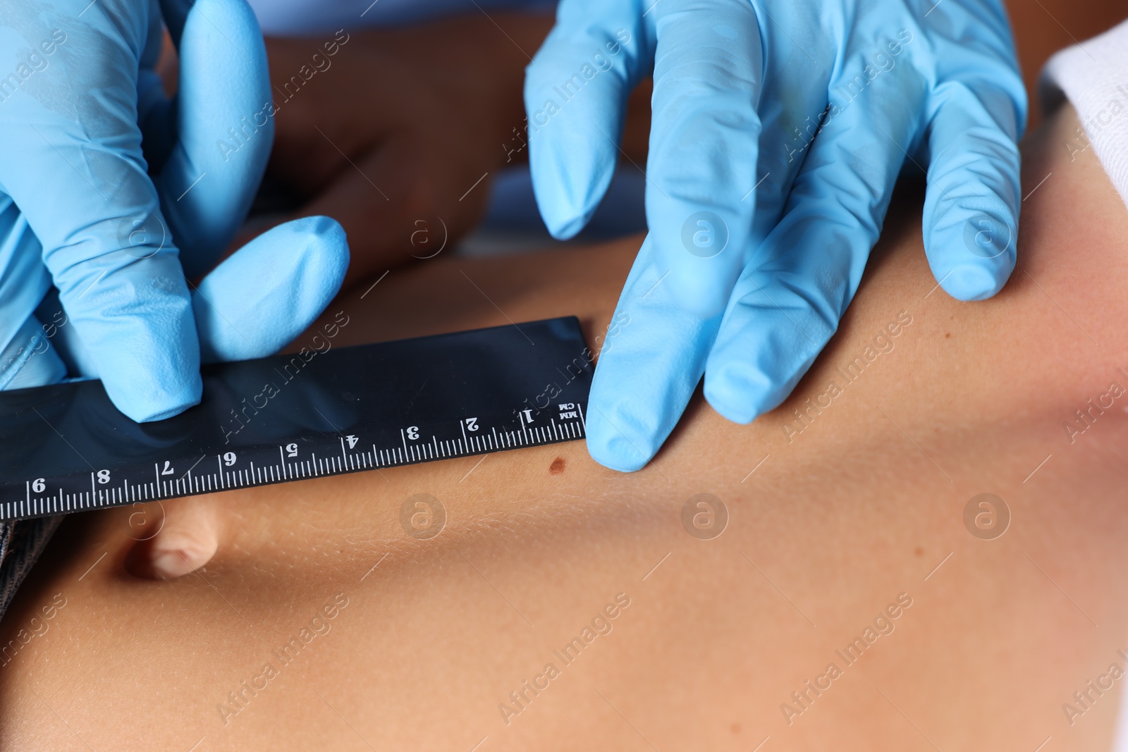 Doctor examining young woman's mole with ruler in hospital, closeup Photo of Doctor examining young woman's mole with ruler in hospital, closeup