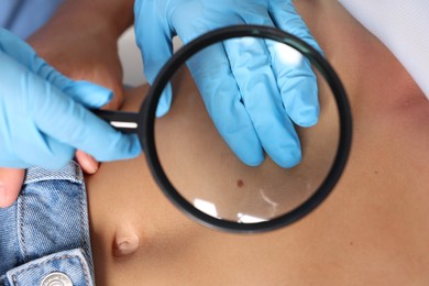 Photo of Doctor examining young woman's mole with magnifying glass in hospital, closeup