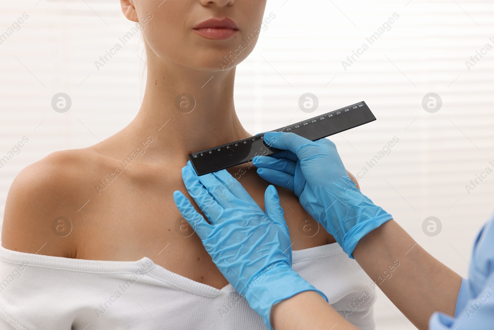 Doctor examining young woman's mole with ruler in hospital, closeup Photo of Doctor examining young woman's mole with ruler in hospital, closeup