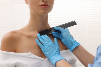 Photo of Doctor examining young woman's mole with ruler in hospital, closeup