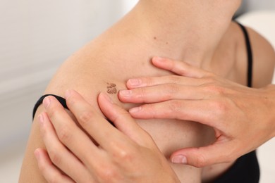 Photo of Doctor examining young woman's mole in hospital, closeup