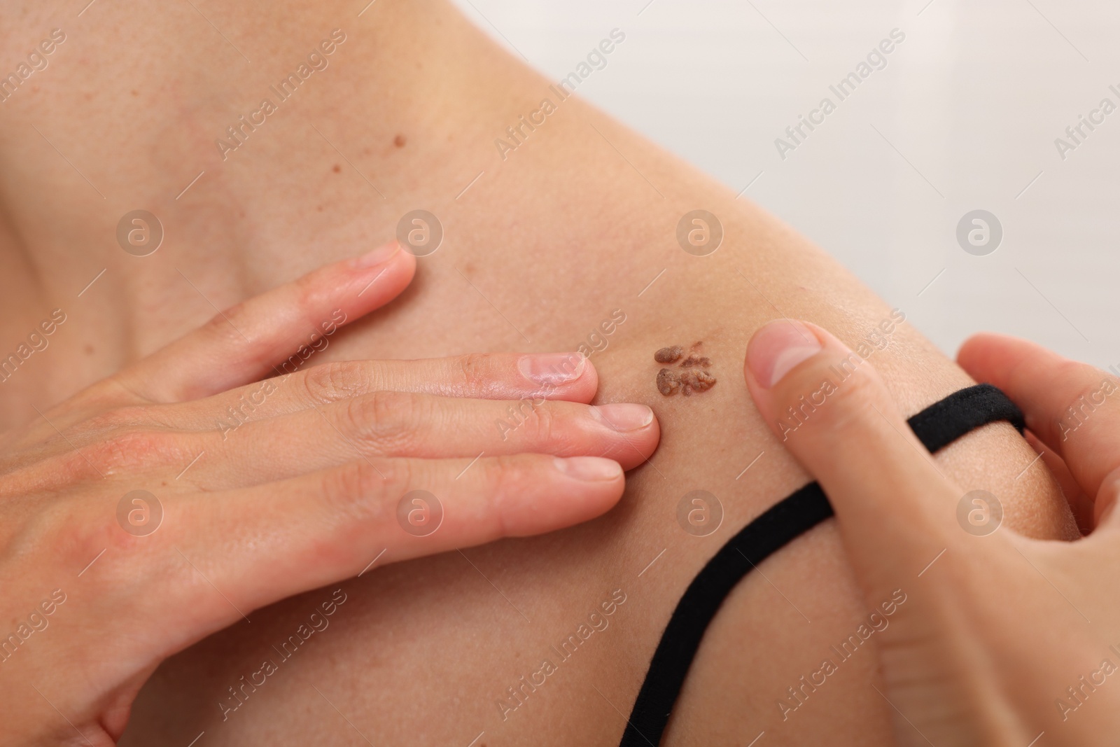Doctor examining young woman's mole in hospital, closeup Photo of Doctor examining young woman's mole in hospital, closeup