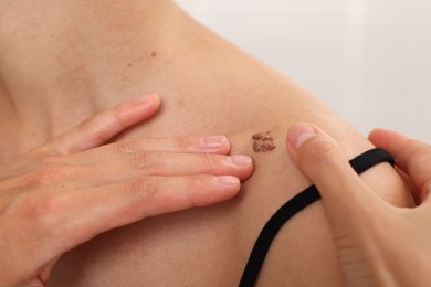 Photo of Doctor examining young woman's mole in hospital, closeup