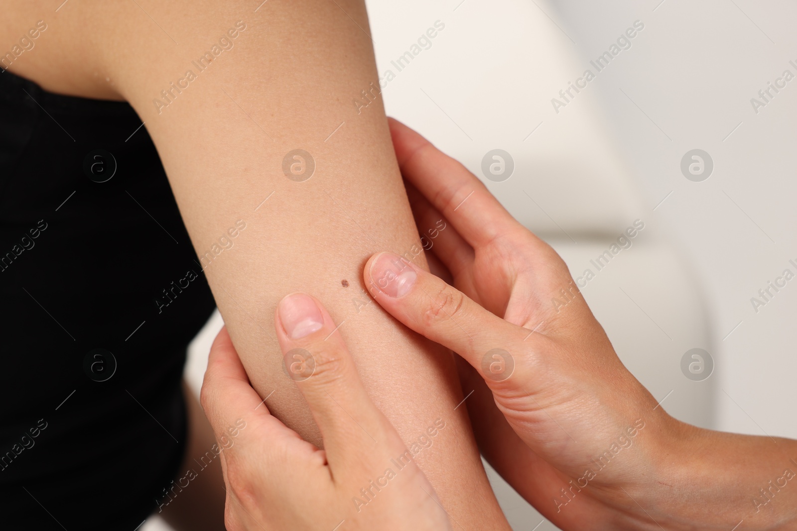 Doctor examining young woman's mole in hospital, closeup Photo of Doctor examining young woman's mole in hospital, closeup
