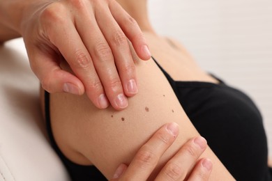 Photo of Doctor examining young woman's mole in hospital, closeup