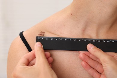 Photo of Doctor examining young woman's mole with ruler in hospital, closeup