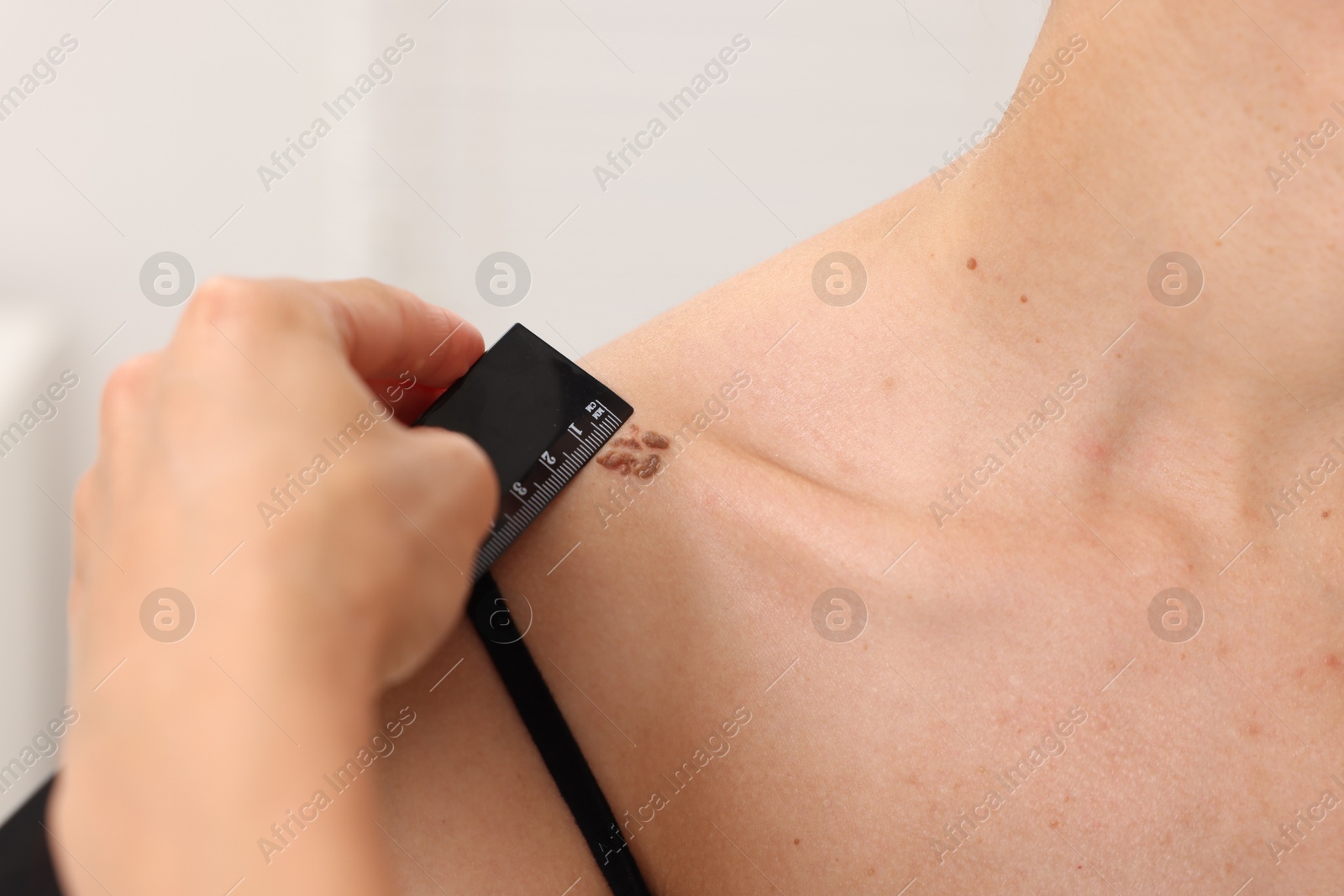 Doctor examining young woman's mole with ruler in hospital, closeup Photo of Doctor examining young woman's mole with ruler in hospital, closeup