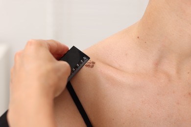 Photo of Doctor examining young woman's mole with ruler in hospital, closeup