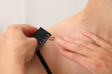 Photo of Doctor examining young woman's mole with ruler in hospital, closeup