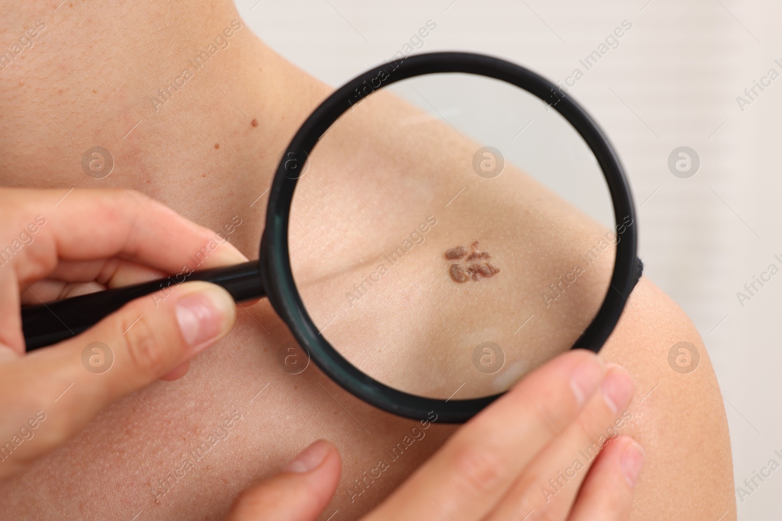 Doctor examining young woman's mole with magnifying glass in hospital, closeup Photo of Doctor examining young woman's mole with magnifying glass in hospital, closeup