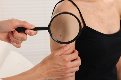 Photo of Doctor examining young woman's mole with magnifying glass in hospital, closeup