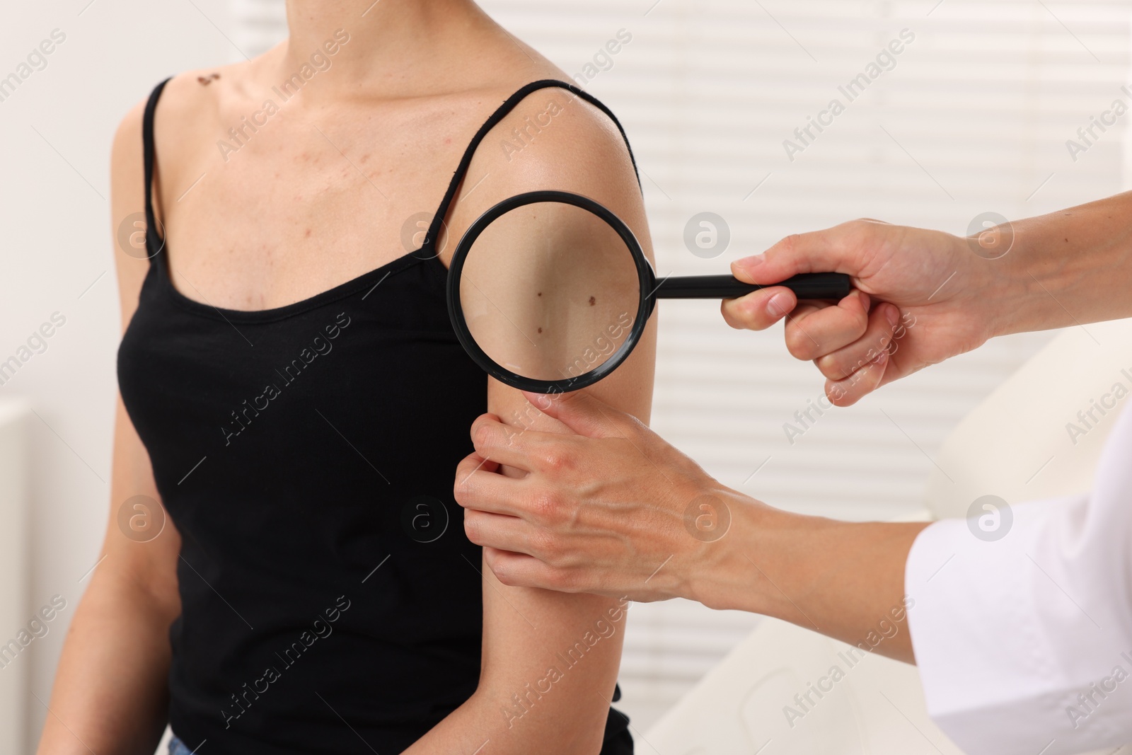 Doctor examining young woman's mole with magnifying glass in hospital, closeup Photo of Doctor examining young woman's mole with magnifying glass in hospital, closeup