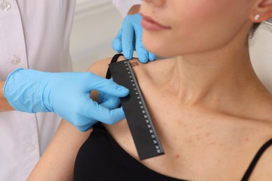 Photo of Doctor examining young woman's mole with ruler in hospital, closeup