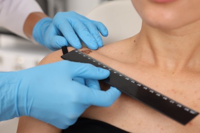 Photo of Doctor examining young woman's mole with ruler in hospital, closeup