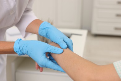 Photo of Doctor examining young woman's mole in hospital, closeup