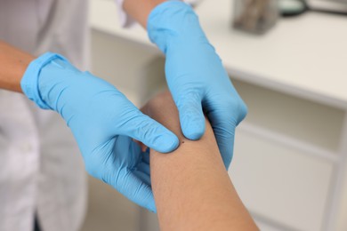Photo of Doctor examining young woman's mole in hospital, closeup