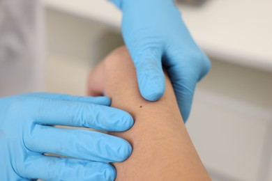 Photo of Doctor examining young woman's mole in hospital, closeup
