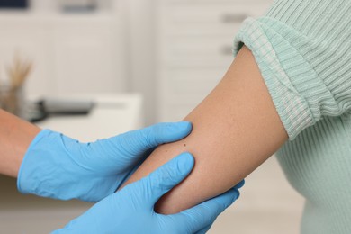 Photo of Doctor examining young woman's mole in hospital, closeup