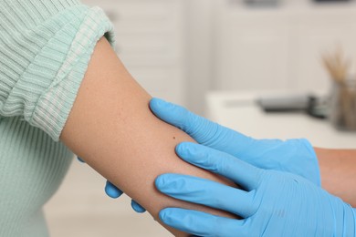 Photo of Doctor examining young woman's mole in hospital, closeup