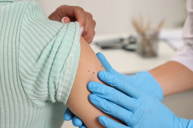 Photo of Doctor examining young woman's mole in hospital, closeup