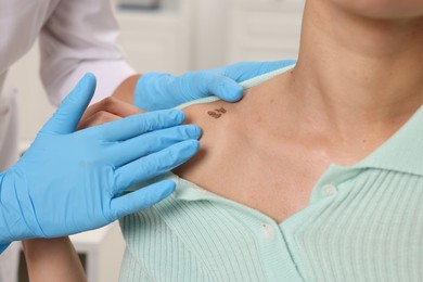 Photo of Doctor examining young woman's mole in hospital, closeup