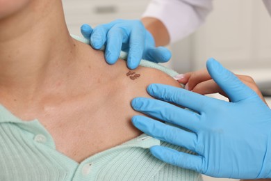 Photo of Doctor examining young woman's mole in hospital, closeup