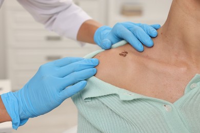 Photo of Doctor examining young woman's mole in hospital, closeup