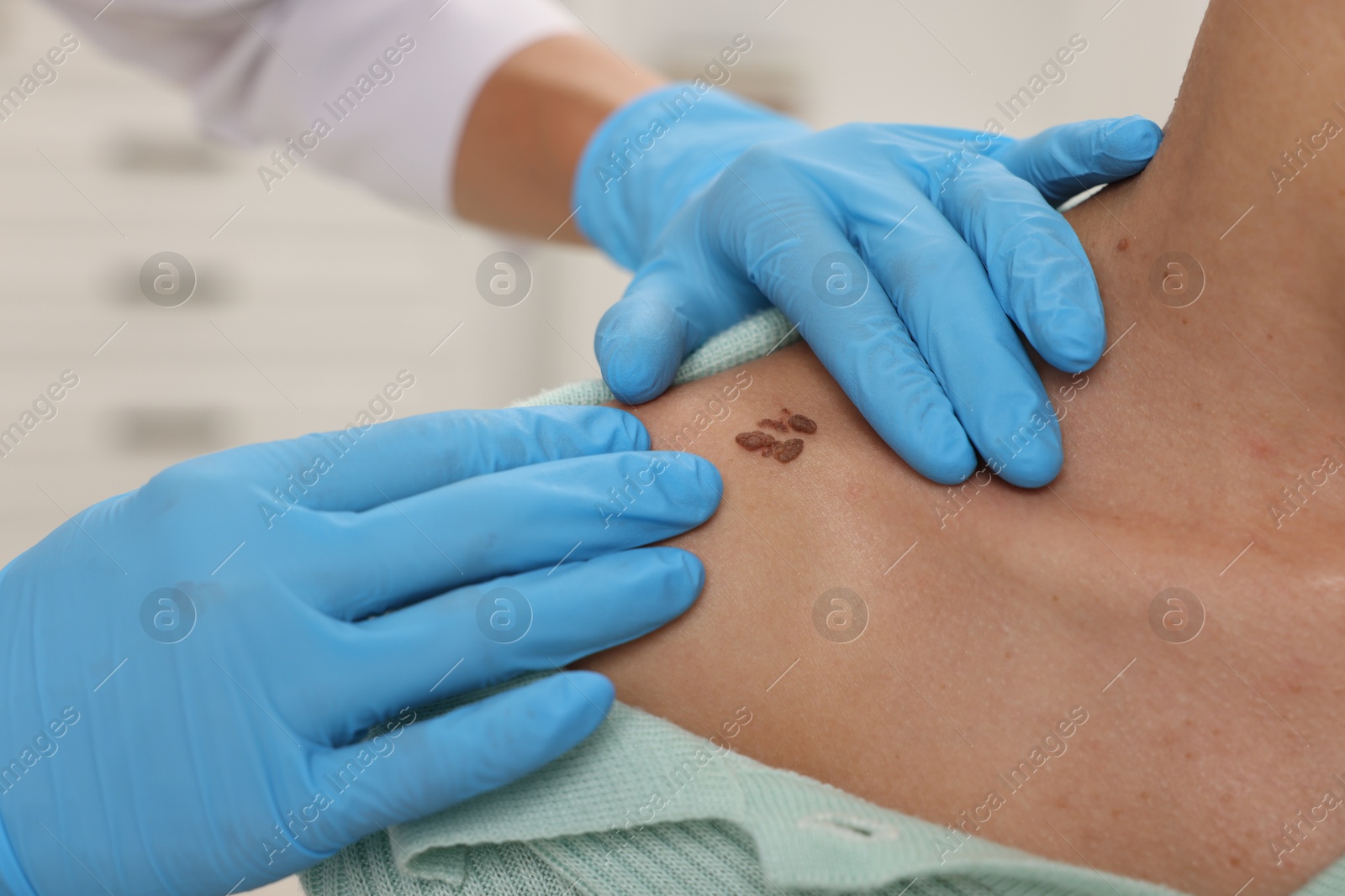 Doctor examining young woman's mole in hospital, closeup Photo of Doctor examining young woman's mole in hospital, closeup