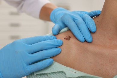 Photo of Doctor examining young woman's mole in hospital, closeup