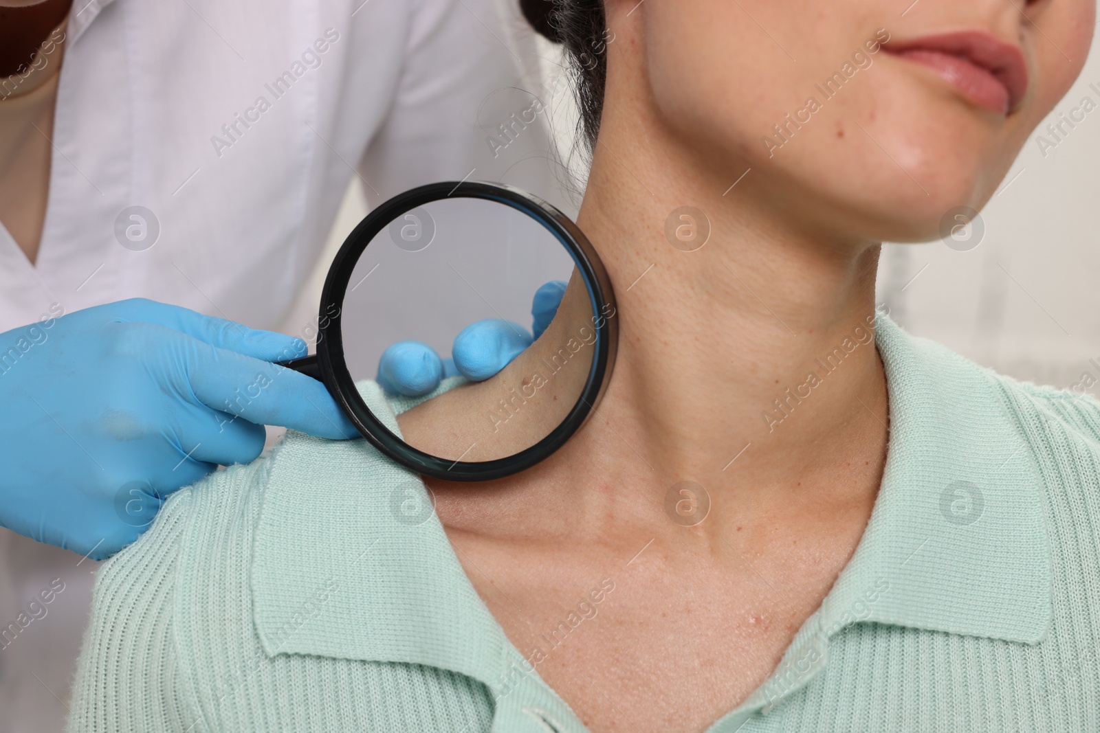 Photo of Doctor examining young woman's mole with magnifying glass in hospital, closeup