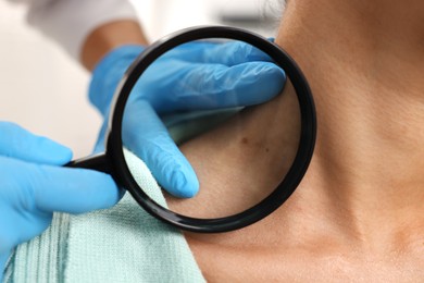 Photo of Doctor examining young woman's mole with magnifying glass in hospital, closeup