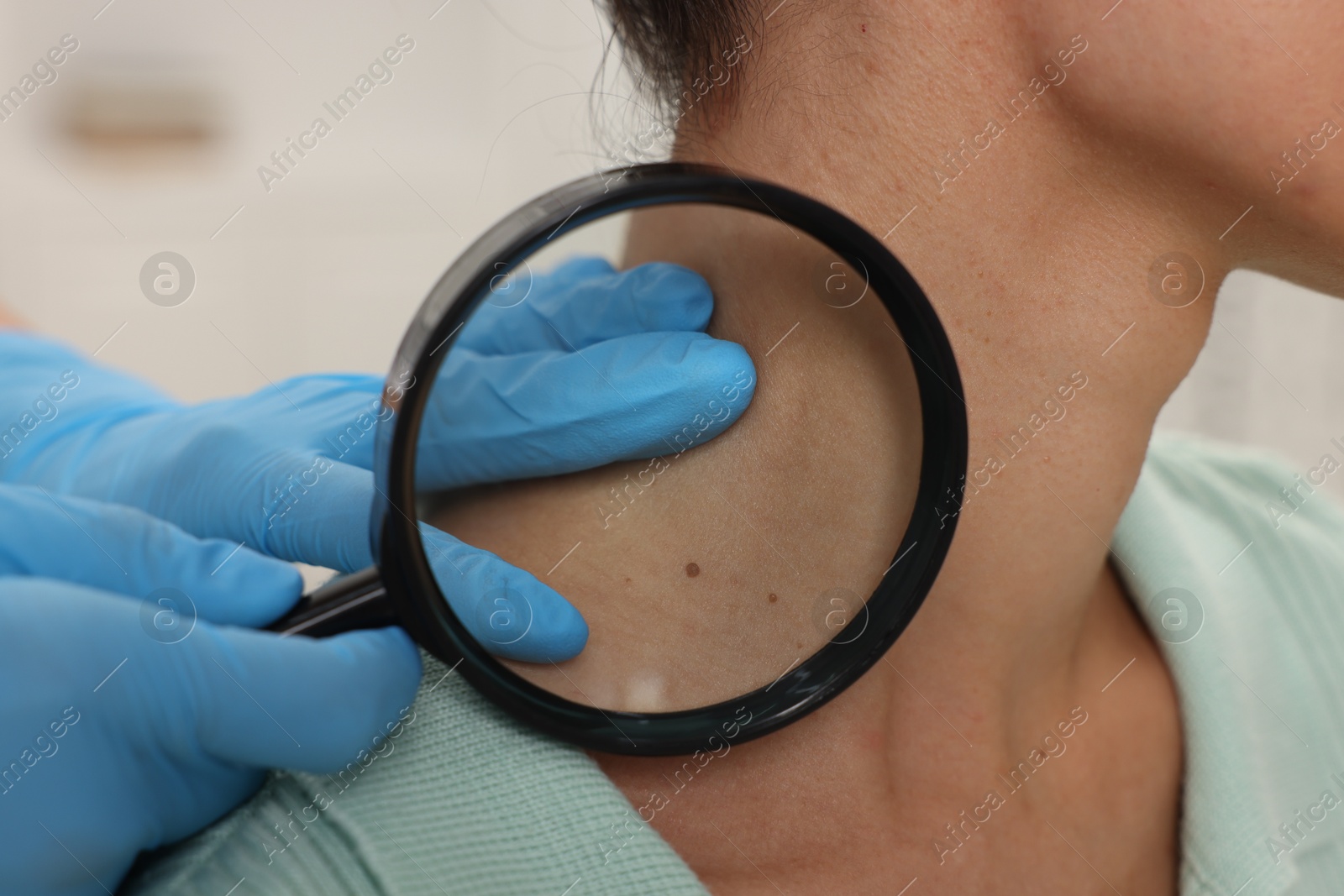 Photo of Doctor examining young woman's mole with magnifying glass in hospital, closeup