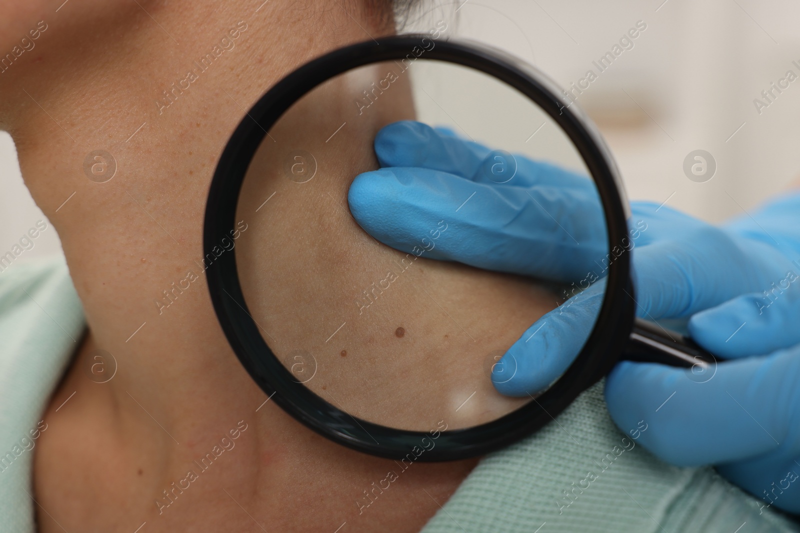 Photo of Doctor examining young woman's mole with magnifying glass in hospital, closeup
