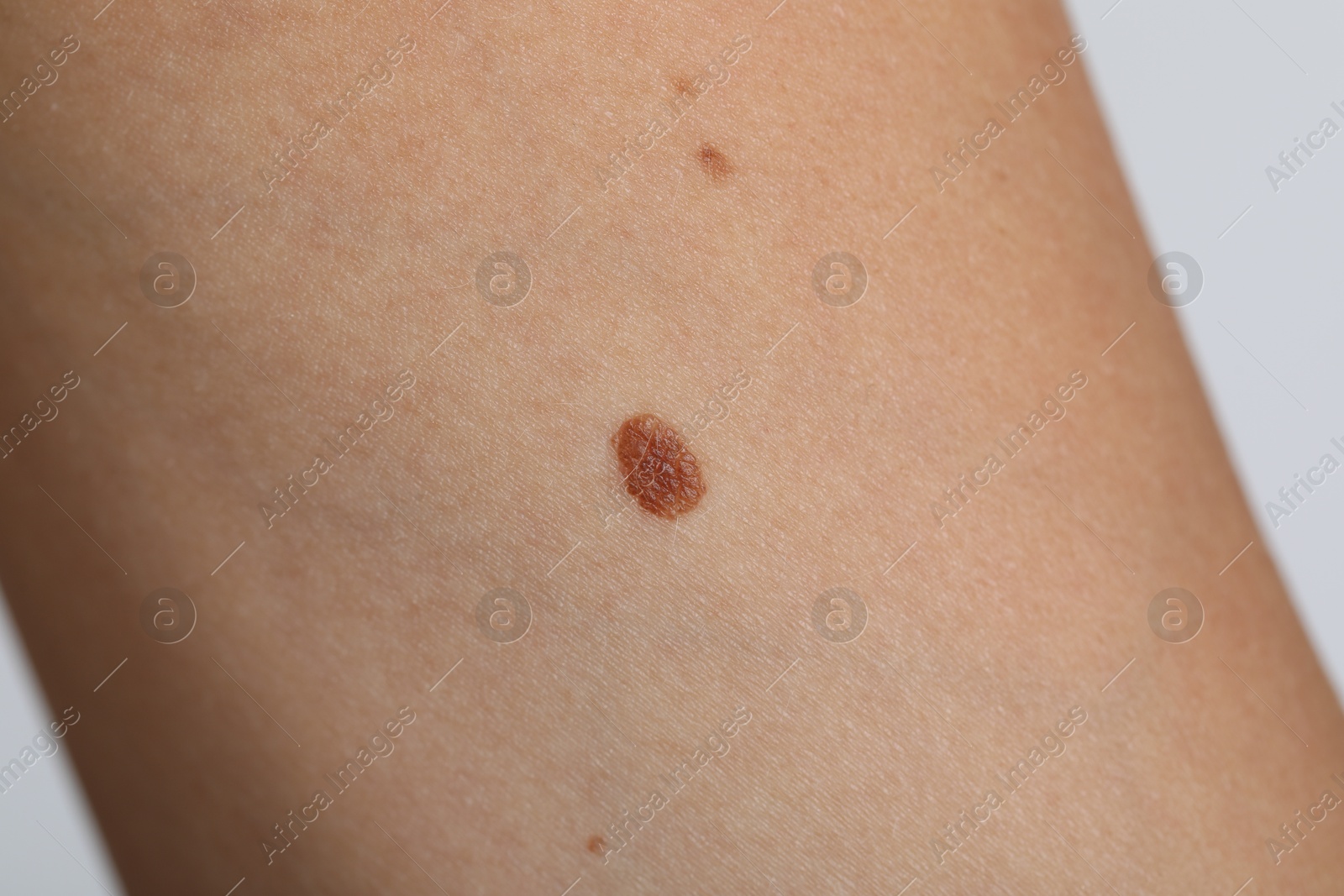 Photo of Woman with moles on her body against light grey background, closeup