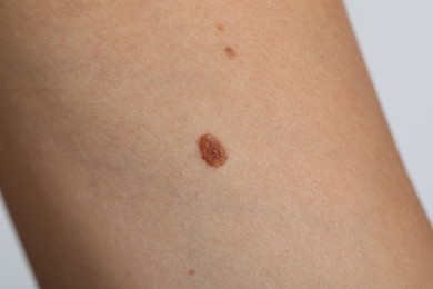 Photo of Woman with moles on her body against light grey background, closeup